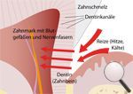 Schmerzempfindliche Zähne Schmerzempfindliche Zähne