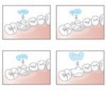 Illustration von Inlays und Onlay