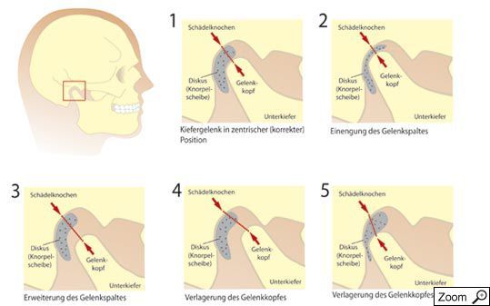 Die craniomandibuläre Dysfunktion Craniomandibuläre Dysfunktion